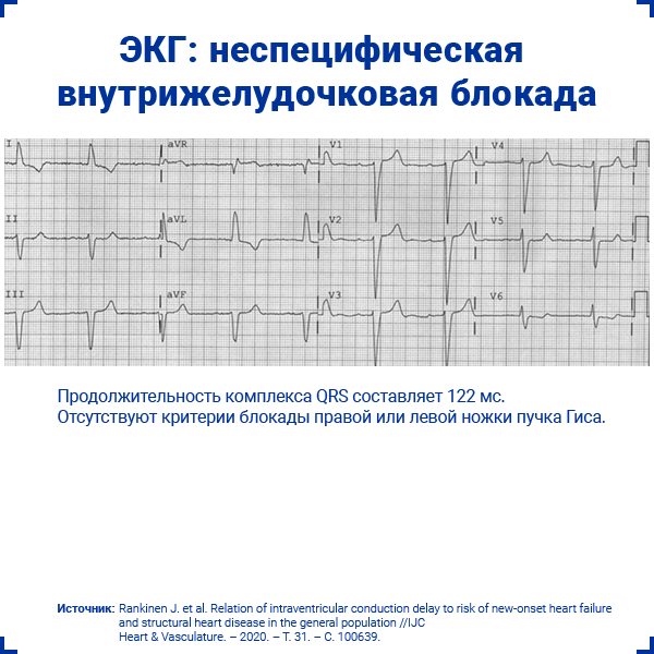 ЭКГ неспецифическая внутрижелудочковая блокада